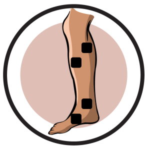 Reflex Sympathetic Dystrophy Lower leg pain electrode pad placement