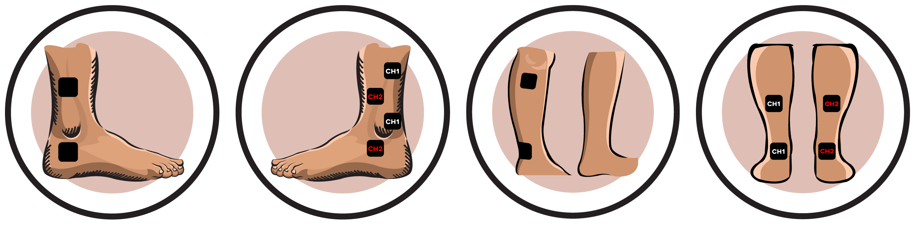 Ankle Electrode Pad Placement 1