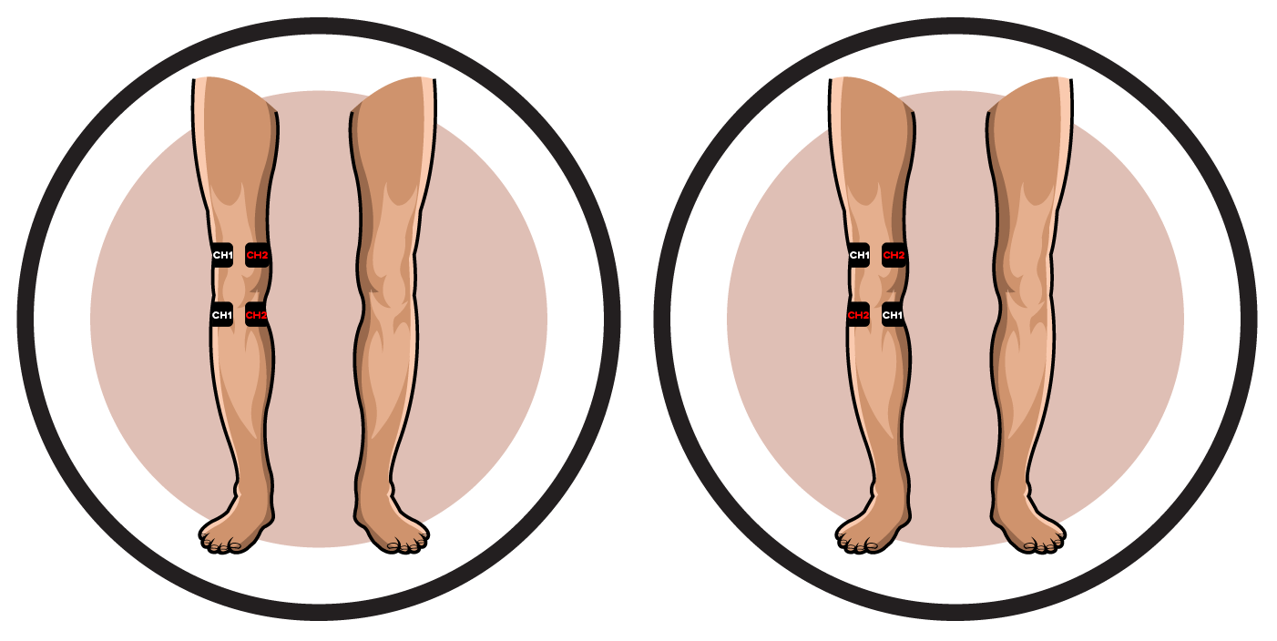 Degenerative Arthritis of Knee Electrode Pad Placement