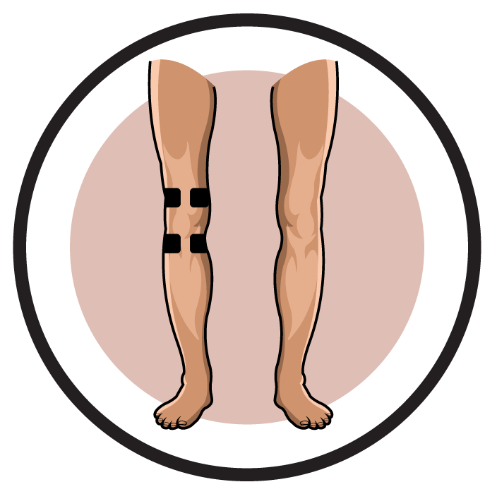 Knee Pain Degenerative Arthritis Electrode Pad Placement